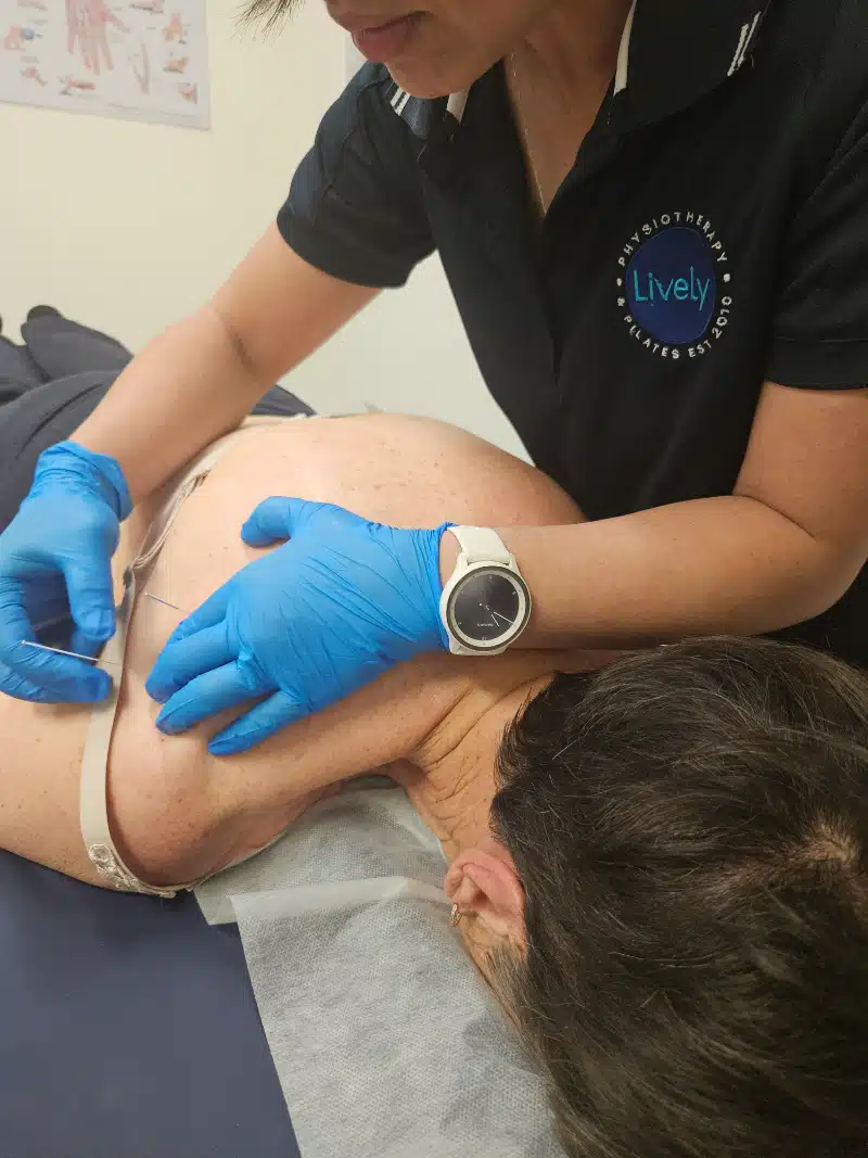 Dry needling